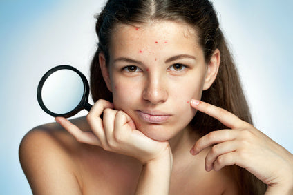 Acne Clearing Program - Virtual