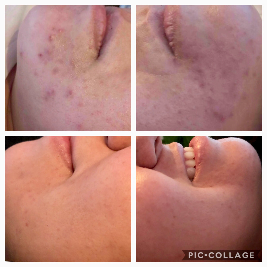 Acne Clearing Program - Virtual