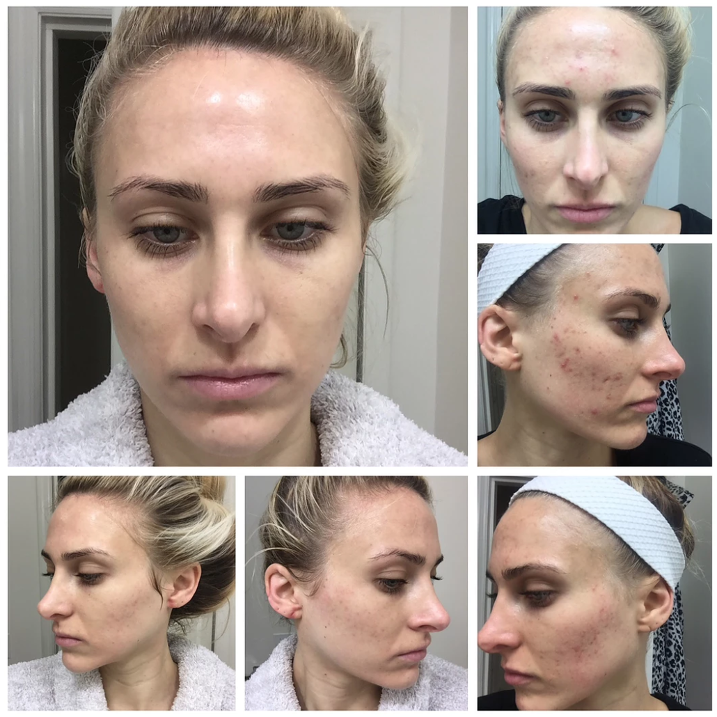 Acne Clearing Program - Virtual