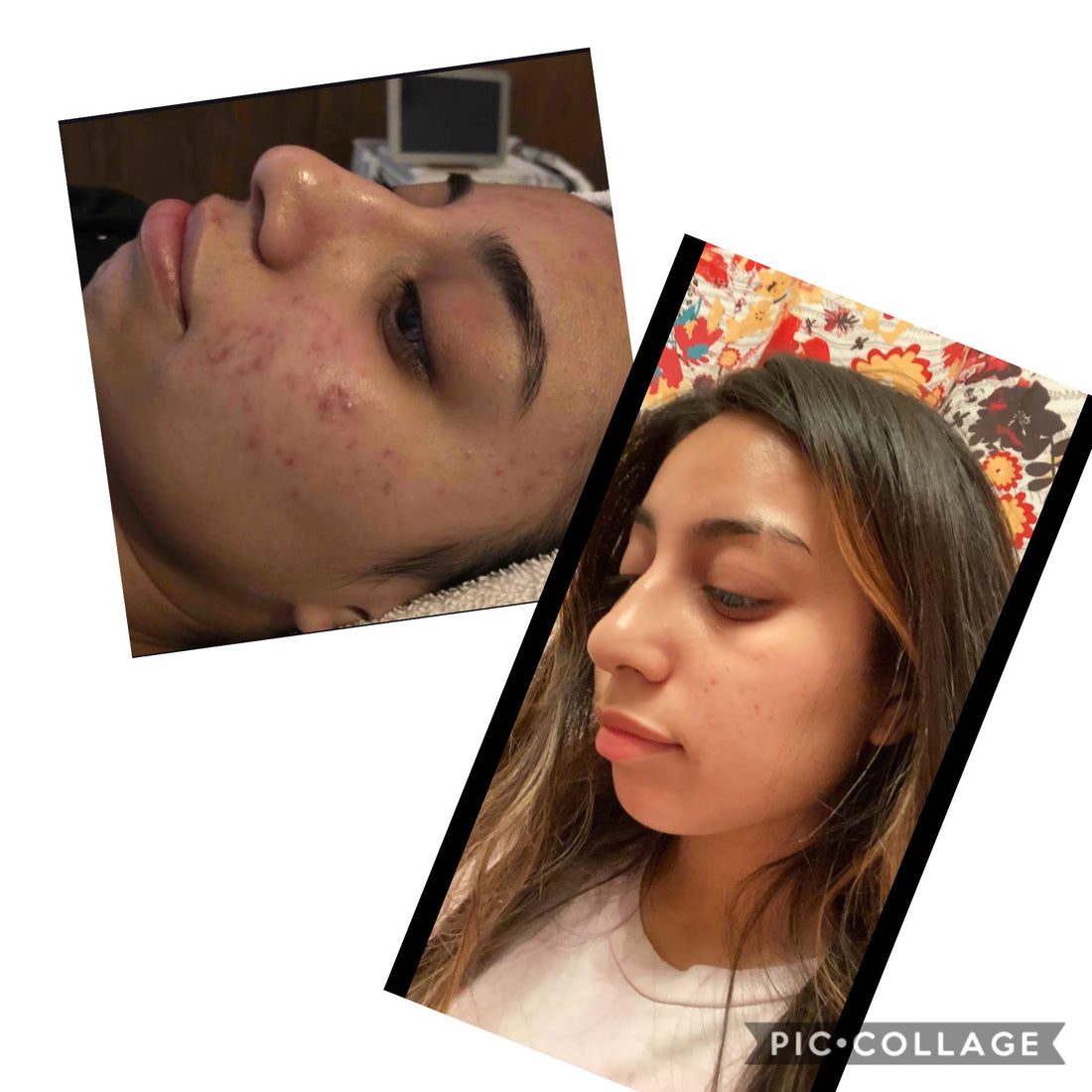 Acne Clearing Program - Virtual