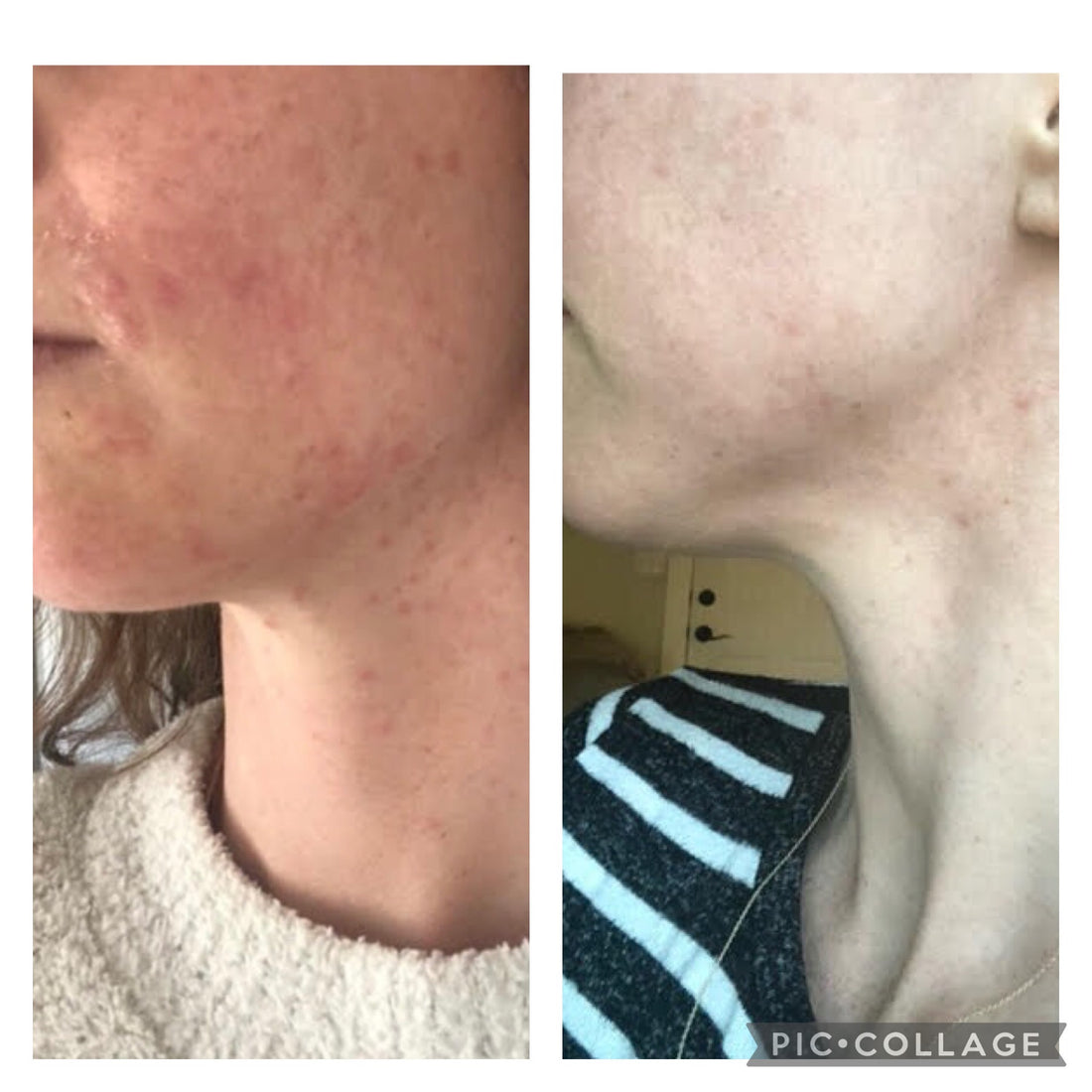 Acne Clearing Program - Virtual