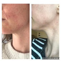 Acne Clearing Program - Virtual