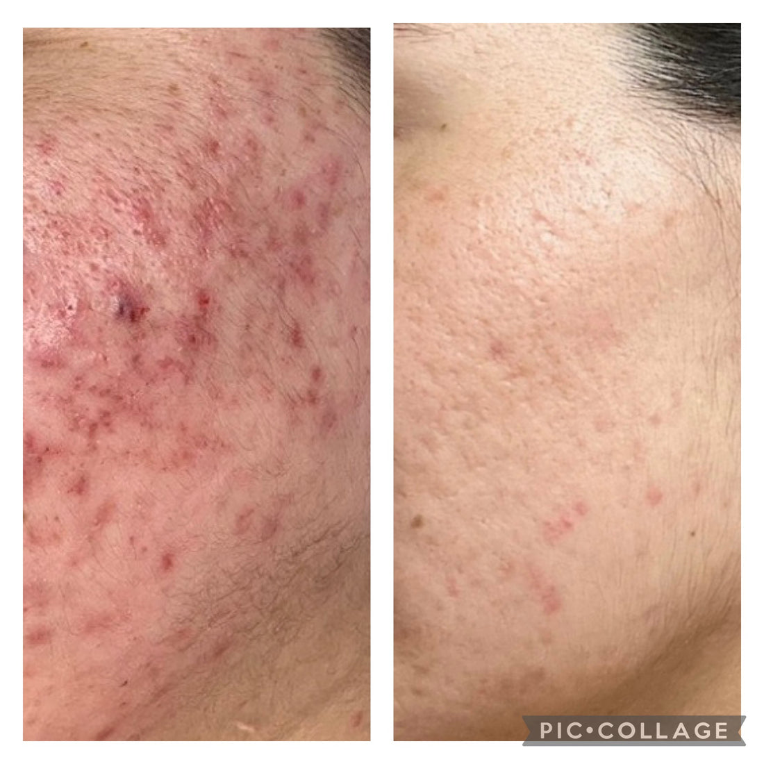 Acne Clearing Program - Virtual