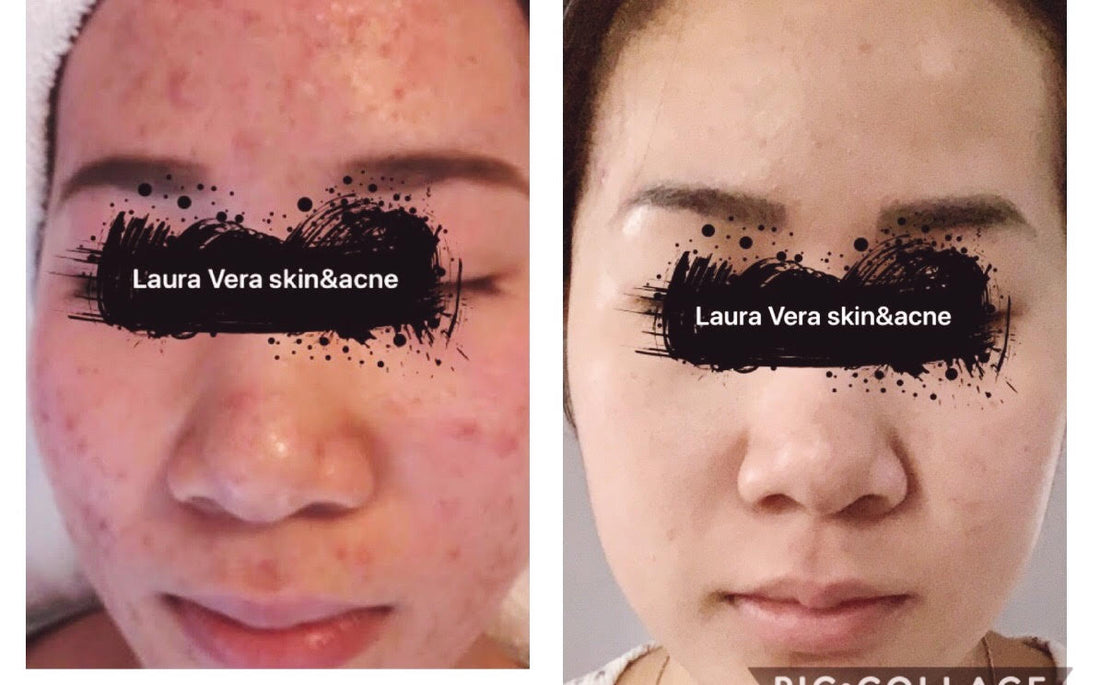 Acne Clearing Program - Virtual