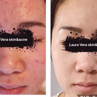 Acne Clearing Program - Virtual
